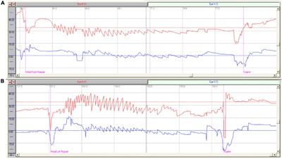The horizontal and vertical components of nystagmus evoked by the supine roll test in horizontal semicircular canal canalolithiasis